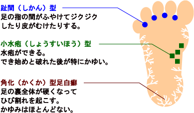 水虫 イソジン